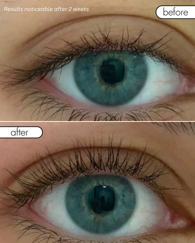 Before and after comparison of a blue eye with visible results after 2 weeks.