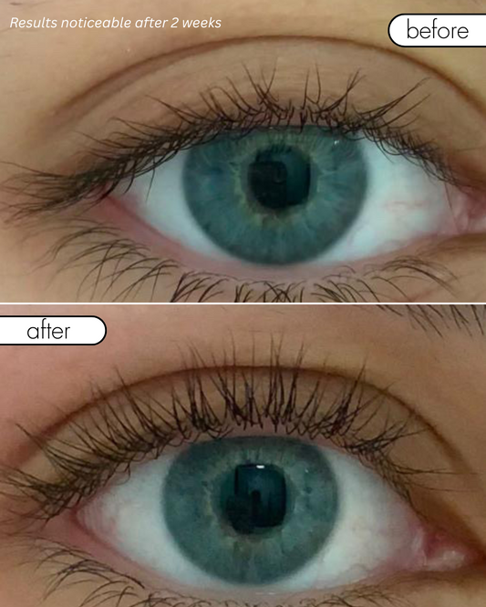 Before and after comparison of a blue eye with visible results after 2 weeks.